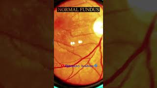 Normal fundus  Normal Retina  Smartphone Fundus Videography  Fundus Photography  Short Video 138 [upl. by Mohandas534]