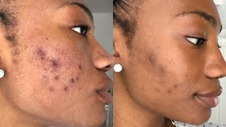 CLEARING UP ACNE SCARRING amp HYPERPIGMENTATION [upl. by Casady]