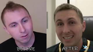 Cassady Campbell Youtuber  Hair Transplant [upl. by Attenat703]