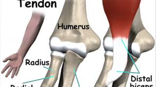 Tendinitis distal del biceps0002 [upl. by Arikahs]