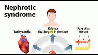 Nephrotic Syndrome  MEDICINE Lectures  NEPHROLOGY  TP 8 [upl. by Holcman]