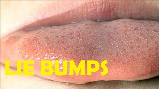 how to get rid of lie bumps on your tongue overnight [upl. by Avehs]