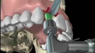 ¡CIRUGIA EN VIVO Colocación De IMPLANTE DENTAL Paso A Paso [upl. by Porte]