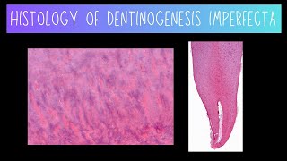 Histology of Dentinogenesis Imperfecta [upl. by Hgielsel]