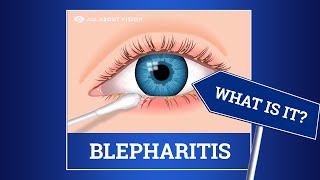 Blepharitis red swollen eyelids Causes Symptoms Treatments [upl. by Pollerd]