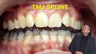 Michigan TMJ Splint tmd tmjpain tmjdisorder tmjtreatment [upl. by Missie]