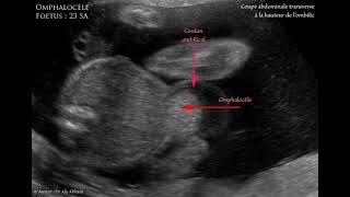 Omphalocèle à 23 SA sans anomalie de caryotype  Description [upl. by Myrlene]