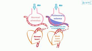 pulmonary edema [upl. by Essilem]