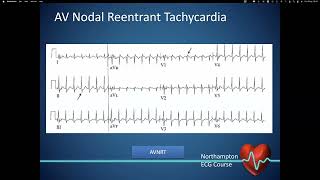 Preexcitation  Dr Jonathan Timperley Consultant Cardiologist Northampton General [upl. by Ragucci]