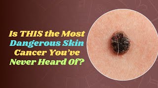 Merkel Cell Carcinoma The Rare Skin Cancer You Can’t Afford to Ignore [upl. by Lu]