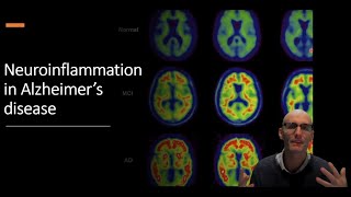 Neuroinflammation in Alzheimers Disease The Role of Microglia [upl. by Anelad]