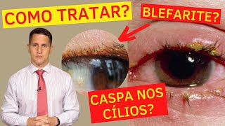 COMO ACABAR COM A CASPA NOS CÍLIOS  TRATAMENTO DA BLEFARITE  Dr Arthur Farache [upl. by Boulanger]