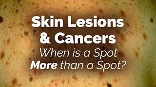 When is a Spot More than a Spot Skin Lesions and Cancers [upl. by Jackson492]