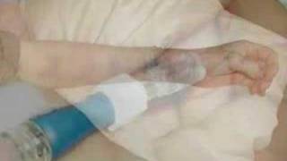 IV problem video from IVTEAM [upl. by Gnas]