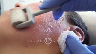 Dermaroller  Microneedling Acne Scars  Skin Resurfacing  Los Angeles California [upl. by Dupuis]