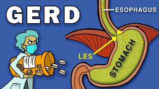 Gastroesophageal Reflux Disease GERD [upl. by Tuddor609]