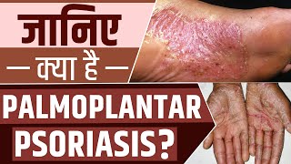 Palmoplantar Psoriasis के लक्षण और इसके उपचार  Psoriasis Specialist Care PsoriasisCareSpecialists [upl. by Bathesda441]