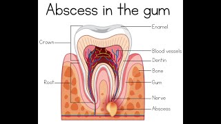 Dental Abscess Causing Trismus  Causes Symptoms Diagnosis Complications and Prevention [upl. by Ahsilak]