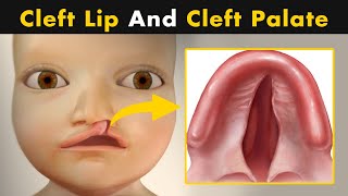 What Causes Cleft Lip And Cleft Palate  symptoms Causes And Treatment UrduHindi [upl. by Briggs]