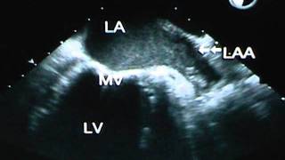 Detection of Left Atrial Appendage Thrombus by TEE [upl. by Demakis]