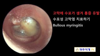 Bullous myringitis 수포성 고막염 [upl. by Artinak]