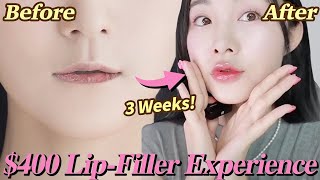 AMAZING RESULTS Before and After Lip Filler 👄  Lyn Beauty [upl. by Oiragelo]