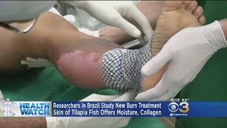 Researchers Experiment With Fish Skin Treatment For Burn Victims [upl. by Sotsirhc]