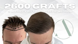 Przeszczep włosów w Turcji 2600 grafts 9 miesięcy [upl. by Mandler992]