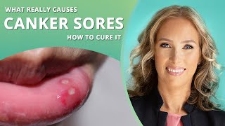 Canker Sores  How to Get Rid of Canker Sores  Dr J9 Live [upl. by Yhtamit]