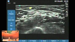 Ultrasound location of Intercostobrachial nerve [upl. by Ahsiuqat]