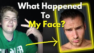 How my face transformed on testosterone surgery Implants Mewing [upl. by Cutler]