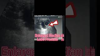 Enlarged Prostate  Prostatomegaly Median Lobe  Prostate Mass on Ultrsound [upl. by Ahsit]