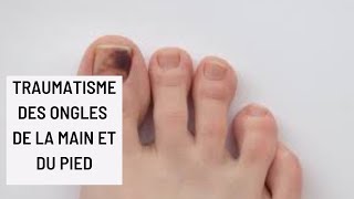 Traumatisme des ongles de la main et du pied [upl. by Dahcir]