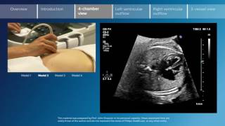 Key screening views of the fetal heart  Part 3  4chamber view [upl. by Marfe362]