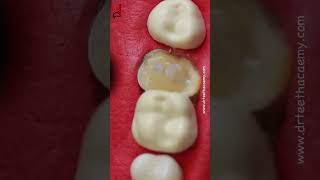 Deep cavity restoration toothcaries toothcavity [upl. by Entirb]