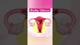 Bulky uterus shorts shortvideo viral [upl. by Ewens]