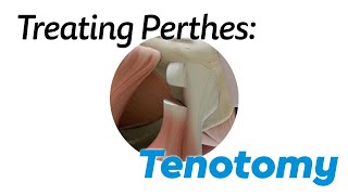 Tenotomy for Treating Perthes Disease in Children [upl. by Repsaj]