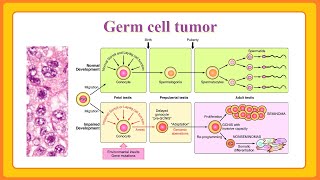 germ cell tumor [upl. by Ferris]