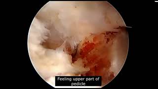 Biportal Endoscopic UBE Lumbar Interbody Fusion EndoTLIF UBE TLIF for Lytic Spondylolisthesis [upl. by Caspar903]