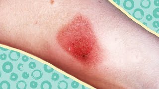 How to Treat Cellulitis [upl. by Hagerman]