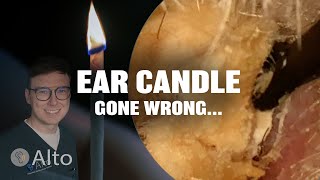 This Ear Candle Makes Hearing WORSE  Ear Wax Removal [upl. by Aehsila697]