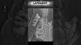 Distal Lopogram  Large bowel  cologram loogopgram [upl. by Danice]