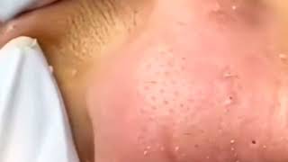 blackheads removal 2023  sac dep spa blackheads removal 2023  skin treatments sac dep spa 2023 44 [upl. by Intihw426]