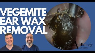 quotVEGEMITEquot EAR WAX REMOVAL  EP885 [upl. by Nitsirt]