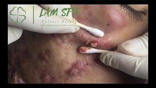 Treatment of acne pustules severe inflammation  MrL Part2  Điều trị mụn mủ viêm nặng  LAMSPA [upl. by Kammerer]