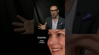 Tipplasty Nasal Tip Rhinoplasty Explained by Dr Kian [upl. by Atihcnoc]