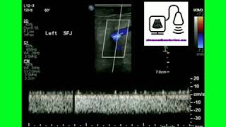 Monophasic Doppler Waveform [upl. by Kesia]