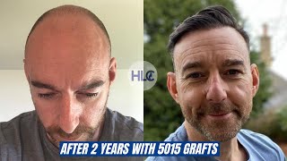 Hair Transplant before and after with 5015 Grafts Amazing Result [upl. by Yerffoeg]