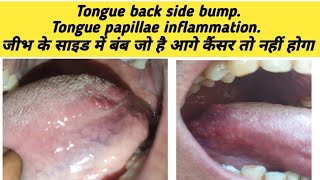 Tongue back side bumpTongue papillae inflammation जीभ के साइड में बंब जो है आगे कैंसर तो नहीं होगा [upl. by Valdemar557]