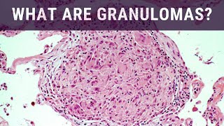 What are Granulomas  Pathology mini tutorial [upl. by Nnylirej]